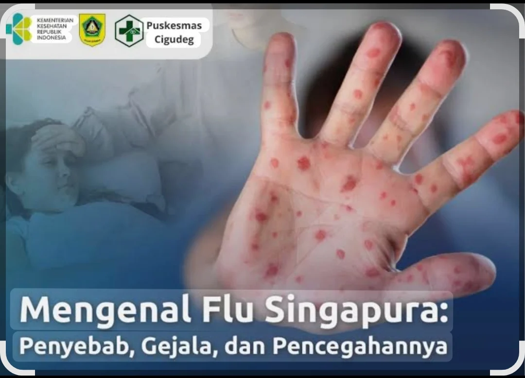 MENGENAL FLU SINGAPURA : Penyebab, Gejala , dan Pencegahannya